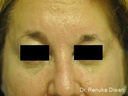 Forehead Creases: Patient 3 - After 1