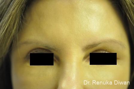 Loss Of Fullness: Patient 10 - After 1