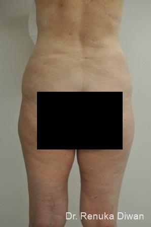 Liposuction: Patient 13 - After 1