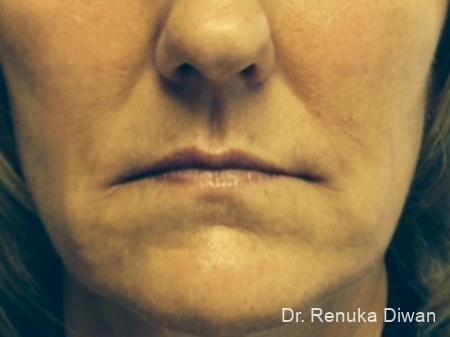 Lips And Mouth: Patient 7 - After 1