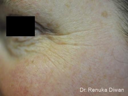 BOTOX® Cosmetic: Patient 21 - Before Image