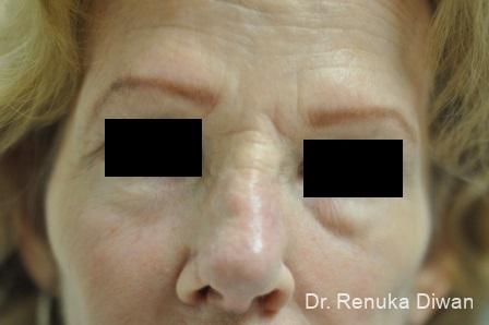 Non-Surgical Rhinoplasty: Patient 1 - After 3