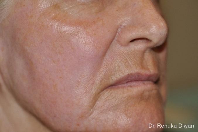 Laser Skin Resurfacing: Patient 7 - After 1