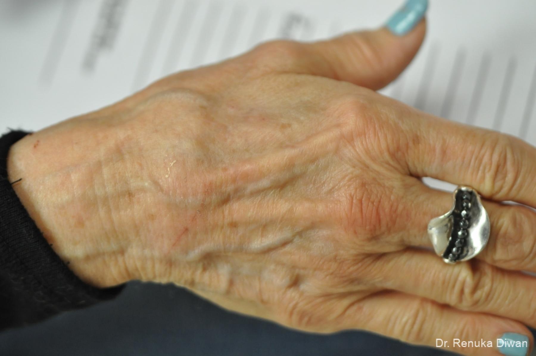 Hand Augmentation: Patient 2 - Before 