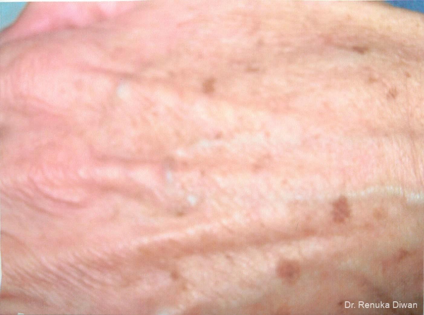 Lasers For Brown Spots: Patient 7 - Before 1