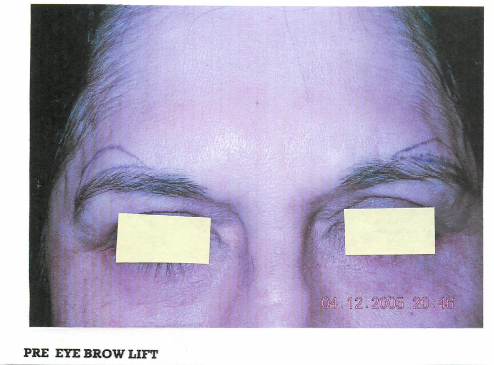 Brow Lift: Patient 1 - Before 