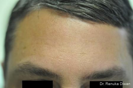 BOTOX® Cosmetic: Patient 16 - After Image