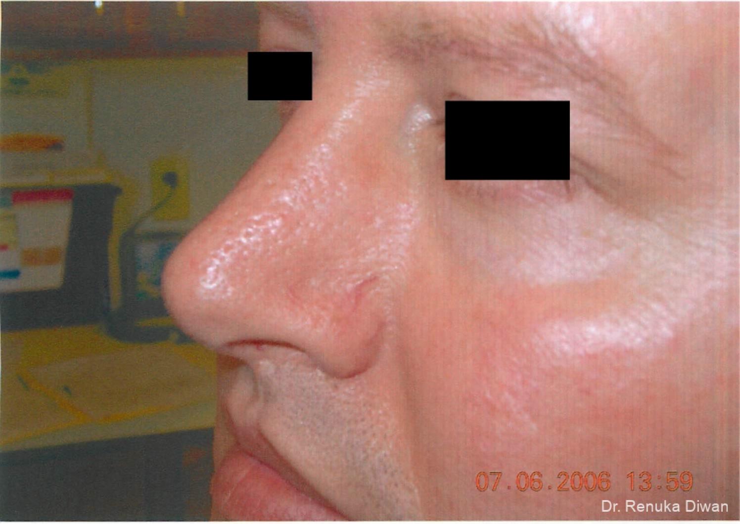 Laser-for-veins-and-redness-for-men: Patient 1 - Before 