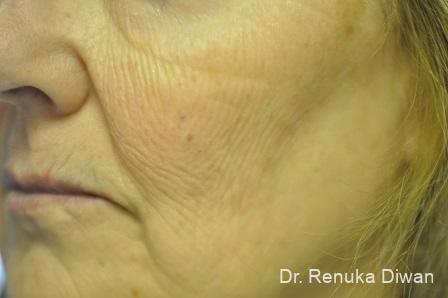 Laser Skin Resurfacing: Patient 8 - Before 1