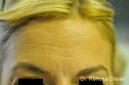 Forehead Creases: Patient 2 - Before 