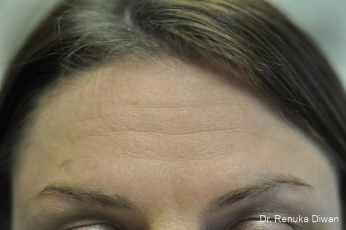 BOTOX® Cosmetic: Patient 17 - Before 1
