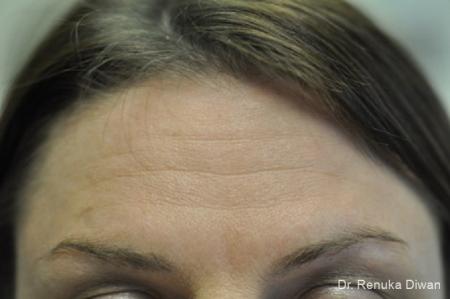 BOTOX® Cosmetic: Patient 17 - Before Image