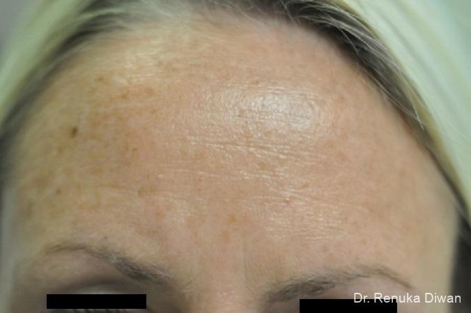 BOTOX® Cosmetic: Patient 9 - Before 1