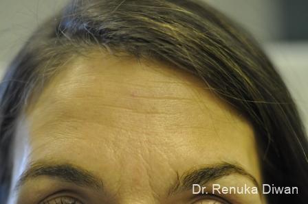 BOTOX® Cosmetic: Patient 15 - Before Image