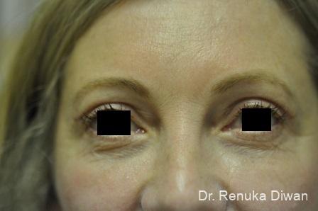 Blepharoplasty: Patient 1 - After  
