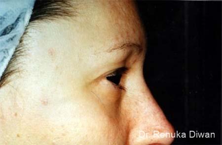 Blepharoplasty: Patient 4 - Before 