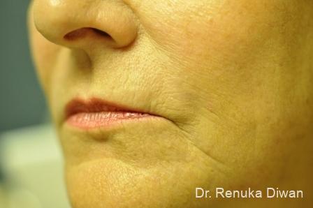 Laser Skin Resurfacing: Patient 2 - After 1