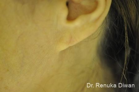 Earlobe Surgery: Patient 3 - After  