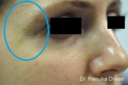 Chemical Peel: Patient 2 - Before 1
