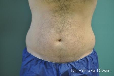 Coolsculpting-for-men: Patient 1 - Before 