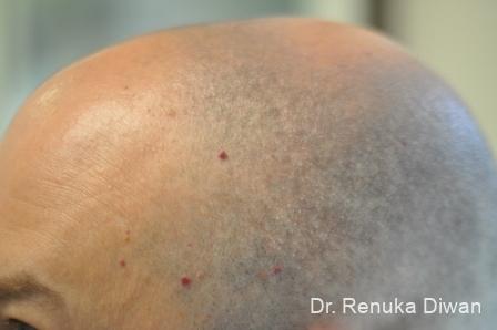 Laser Treatment Of Angiomas: Patient 1 - Before