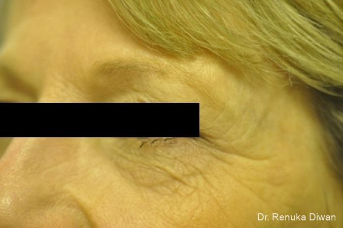 Microneedling: Patient 1 - Before 