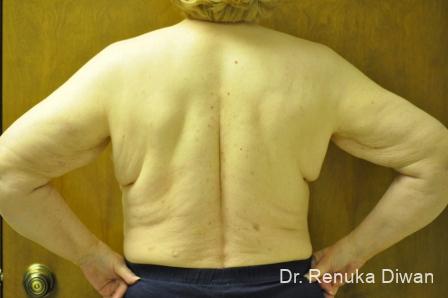 Liposuction: Patient 19 - After 2