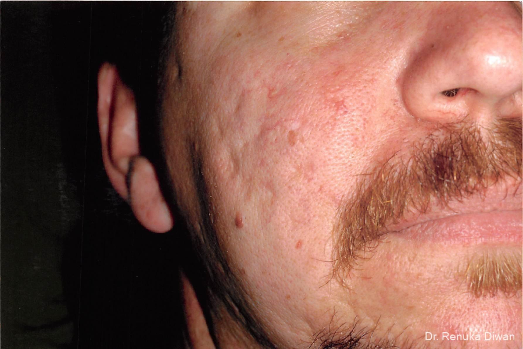 Acne Scars: Patient 1 - Before 