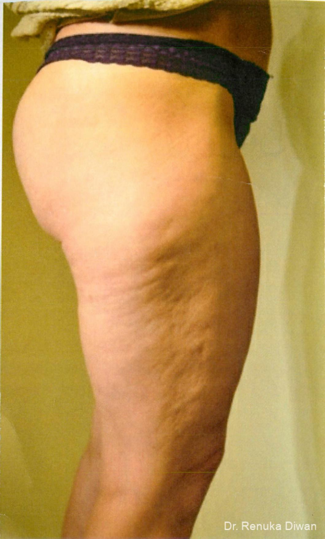 Cellulite Reduction: Patient 2 - Before 1