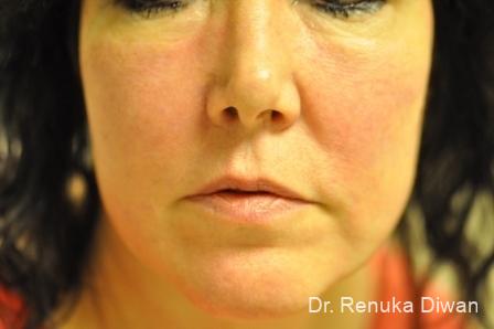 Laser For Veins And Redness: Patient 7 - Before 