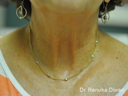 Skin Tightening: Patient 2 - After  