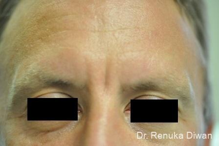 Botox-cosmetic-for-men: Patient 2 - Before 