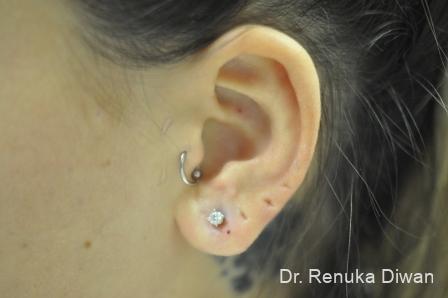 Earlobe Surgery: Patient 6 - After 1