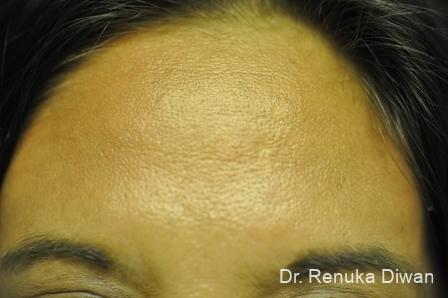 BOTOX® Cosmetic: Patient 13 - After Image