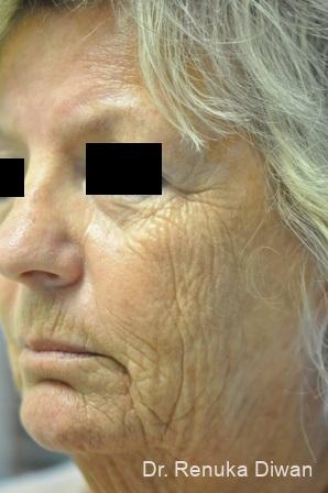 Laser Skin Resurfacing: Patient 6 - Before 