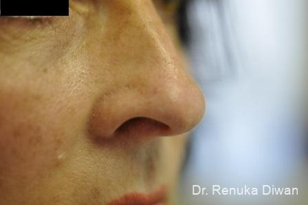 Laser For Veins And Redness: Patient 17 - After 1