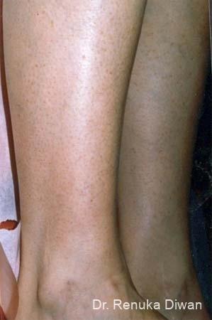 Veins On Legs: Patient 1 - After  