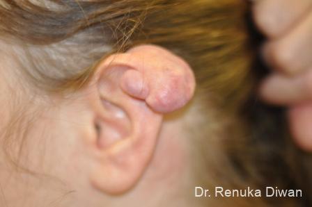 Earlobe Surgery: Patient 7 - Before 