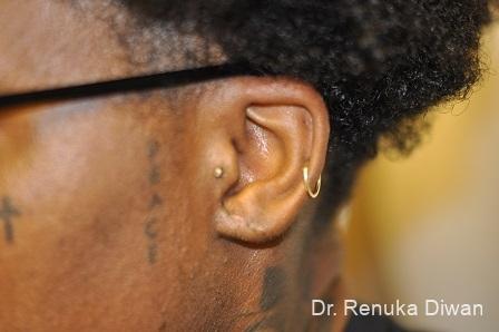 Earlobe Surgery: Patient 8 - After 1