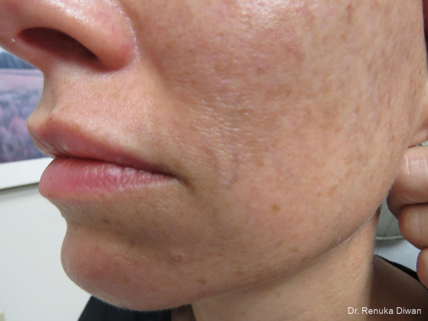 Laser For Veins And Redness: Patient 35 - Before and After 2