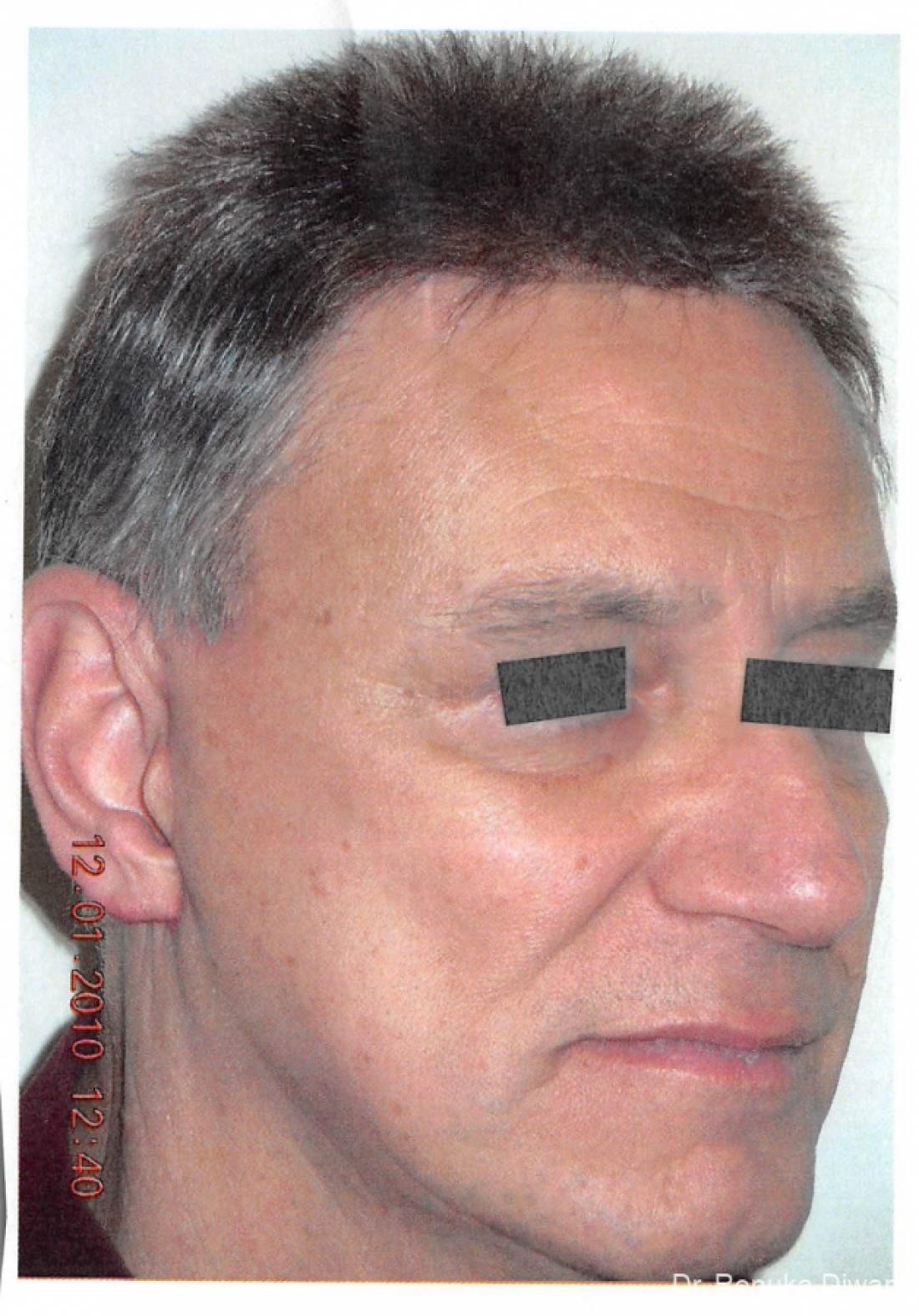 Facelift For Men: Patient 1 - After 1