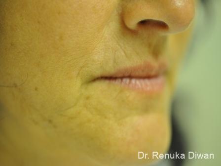 Lips And Mouth: Patient 10 - Before 