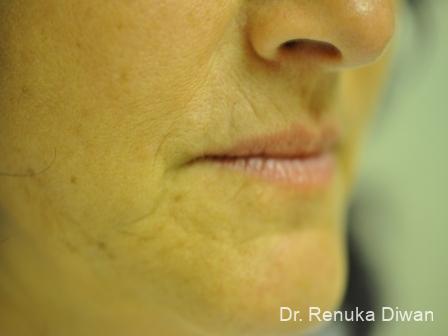 Lips And Mouth: Patient 11 - Before 1