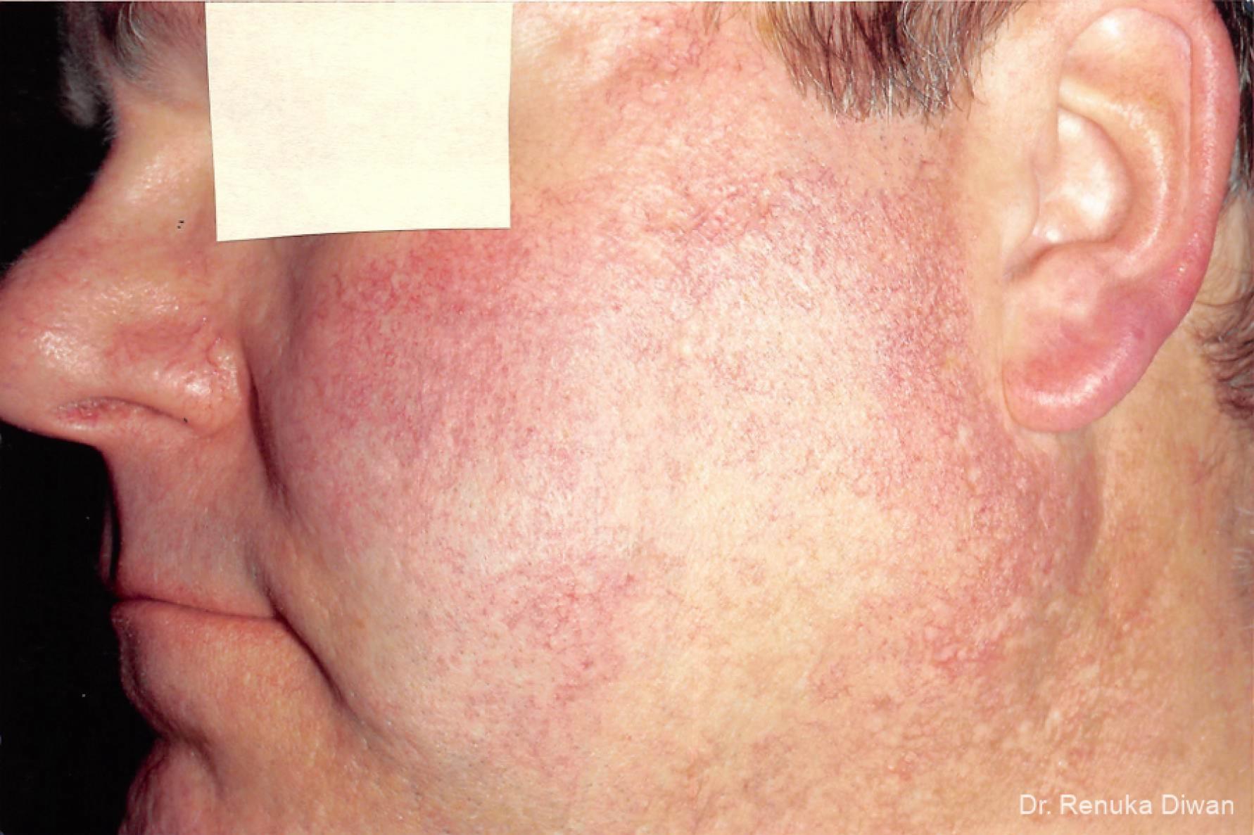 Laser-for-veins-and-redness-for-men: Patient 4 - Before 