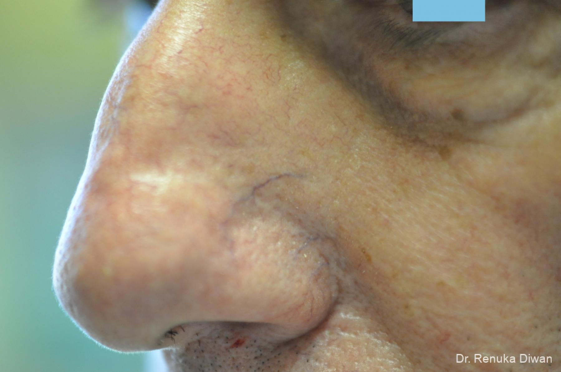 Laser For Veins And Redness For Men: Patient 8 - Before 1