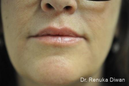 Marionette Lines: Patient 10 - After  