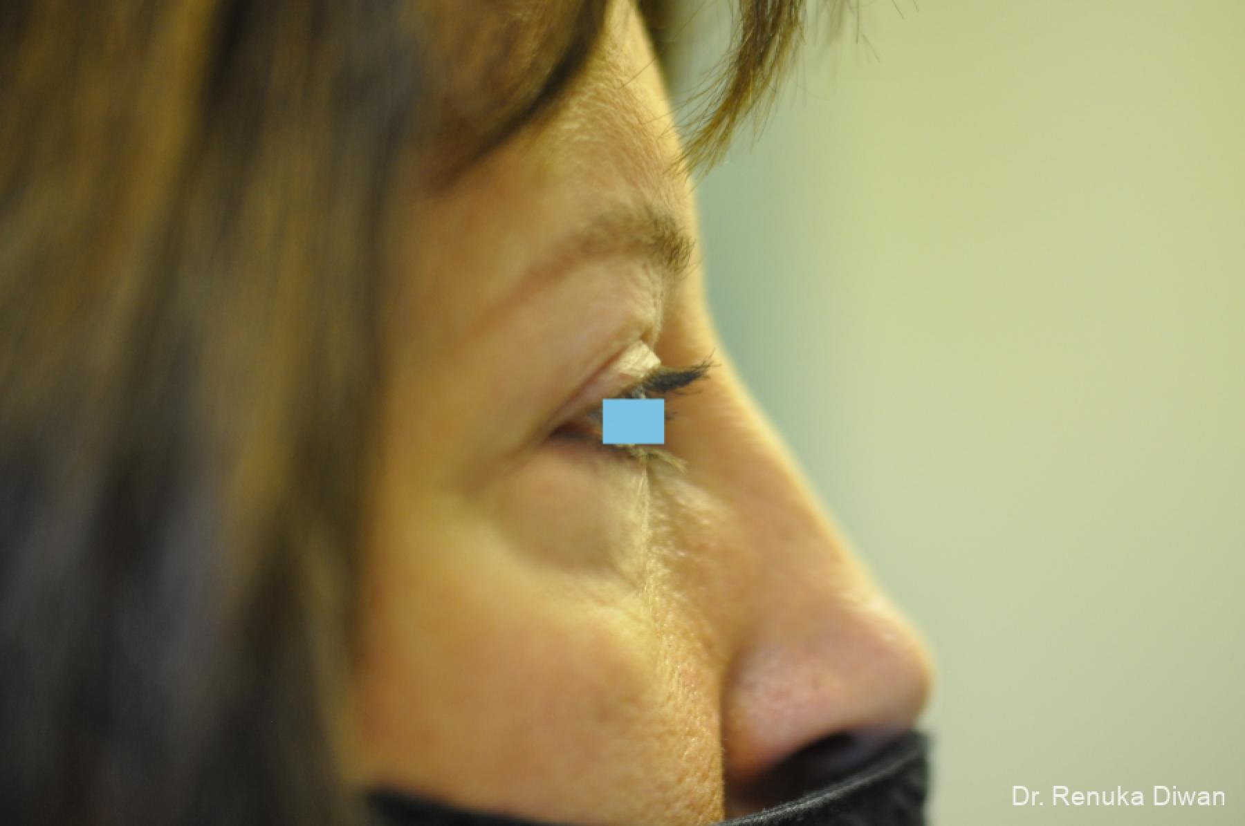 Blepharoplasty: Patient 3 - After 3