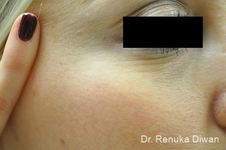 Laser For Veins And Redness: Patient 10 - After 1