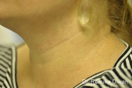 Neck Creases: Patient 1 - Before and After 2