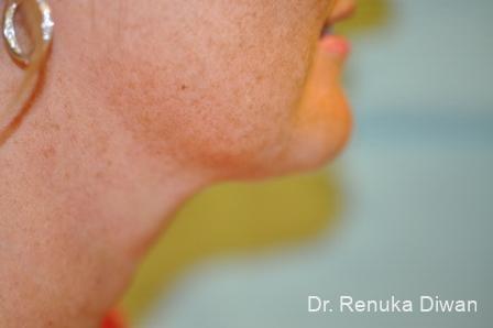 Kybella: Patient 1 - After  